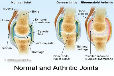 Exercise and joint pain illustrated